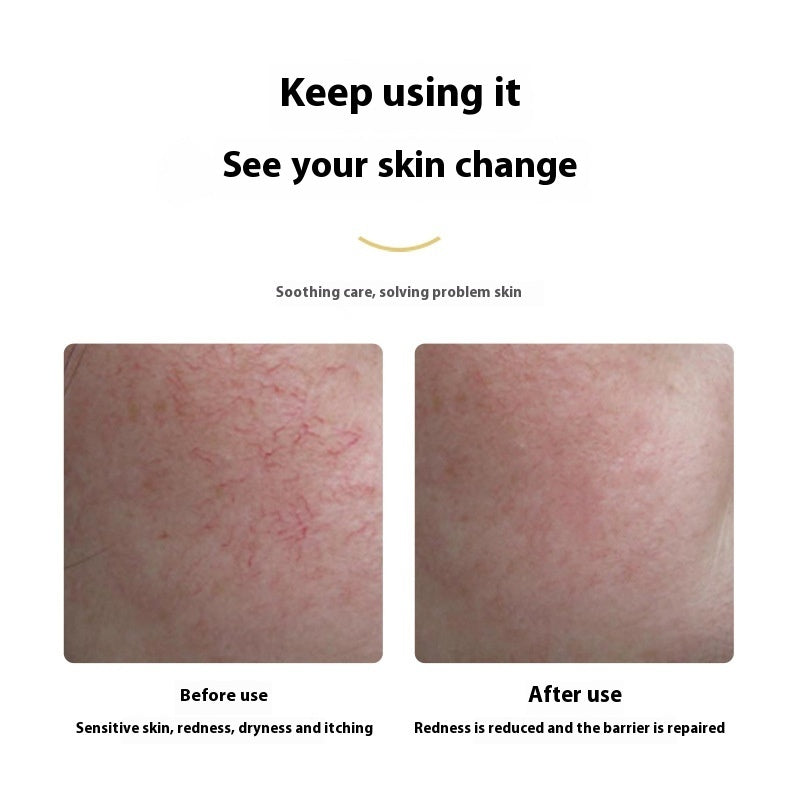 Sensitive Skin Red Blood Silk Repair Lotion